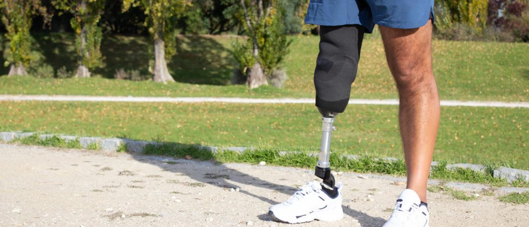 Czego unikać po amputacji kończyny?